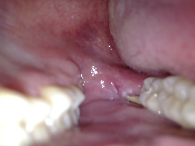 extraction dent avec abces extraction dent avec abces